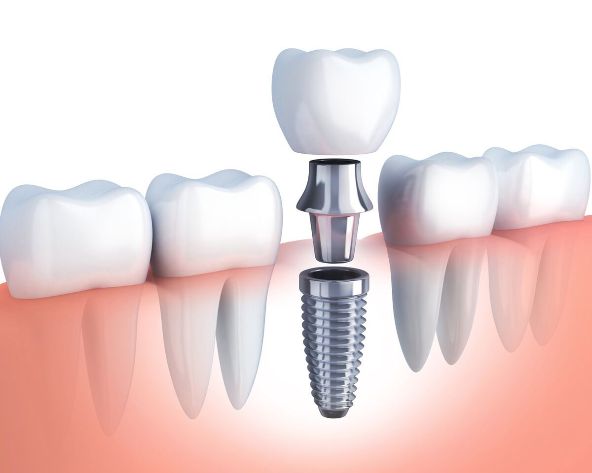 WkgT4_ag dental implants melbourne