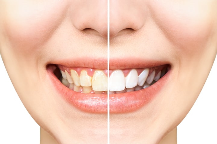 DOES DENTAL BONDING LOOK NATURAL min DOES DENTAL BONDING LOOK NATURAL min