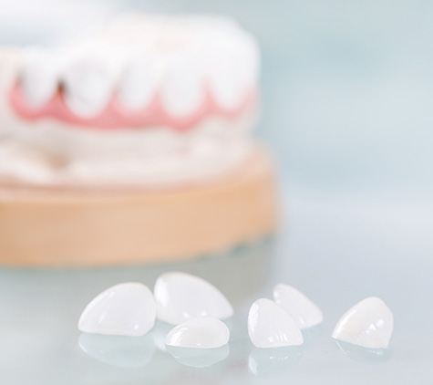 dental veneers 333 dental veneers 333